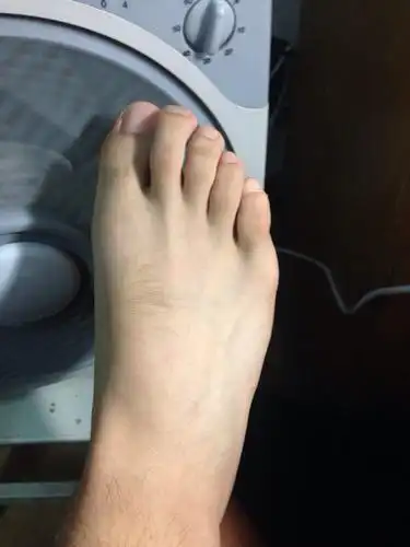 问:最近打篮球,然后回来洗澡完发现,右脚第五跖骨(脚掌骨)疼,踩地疼