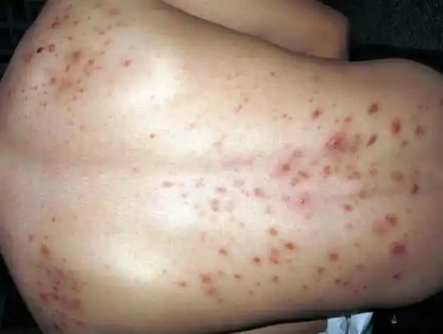 背上长痤疮可能是马拉色菌感染毛囊炎治疗需要注意