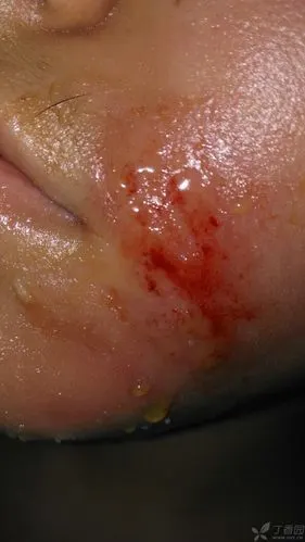 渗出后结痂结皮.请同道们给予帮助.