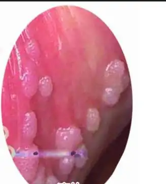 尖锐湿疣男性初期图片