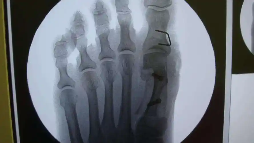 大脚骨scarf akin截骨 - 好大夫在线