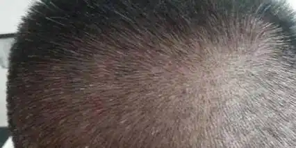 为什么头皮上长脓包和疙瘩?医生提醒:3种病要考虑在内