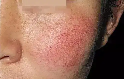 反复发作为什么你脸上的红血丝就是好不了