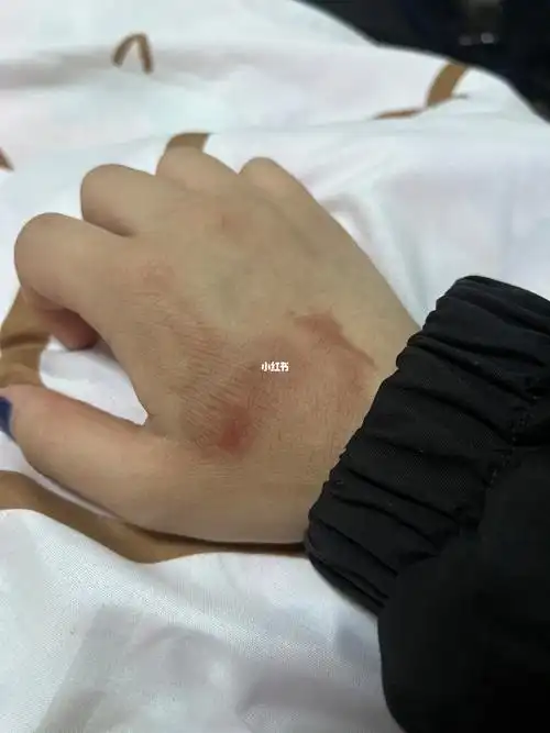 没起泡,没脱皮就是伤口变黑了,皱巴巴的会留疤痕吗?