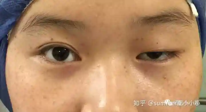 由于动眼神经麻痹或重症肌无力等所致,就是神经跟肌肉接头之间,少了一