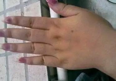 手背上长痣算命