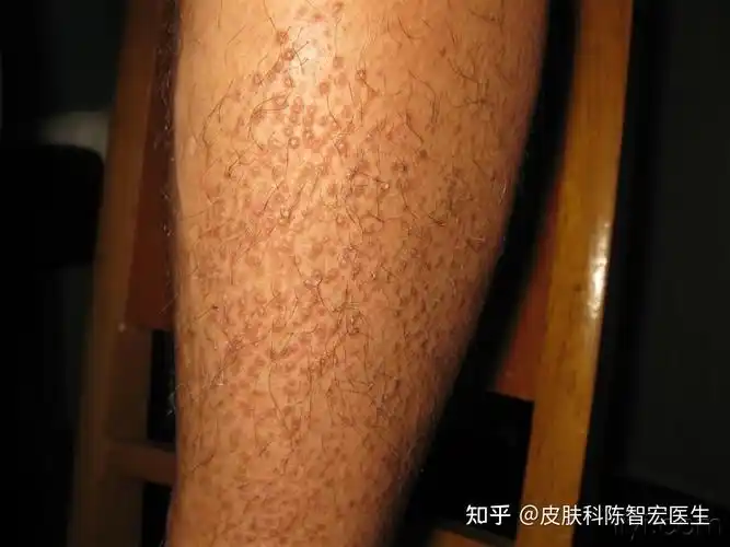 皮肤淀粉样变的中医外治法