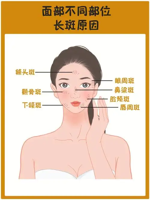 斑女朗71脸上不用部位长斑的原因