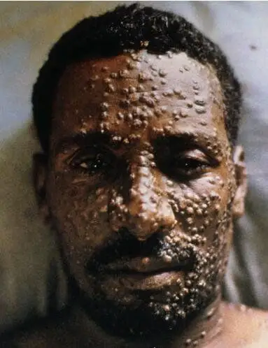 超恶心的密集恐惧症图片大全密集测试图欢迎挑战慎入3