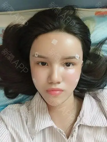 自体脂肪填充全脸