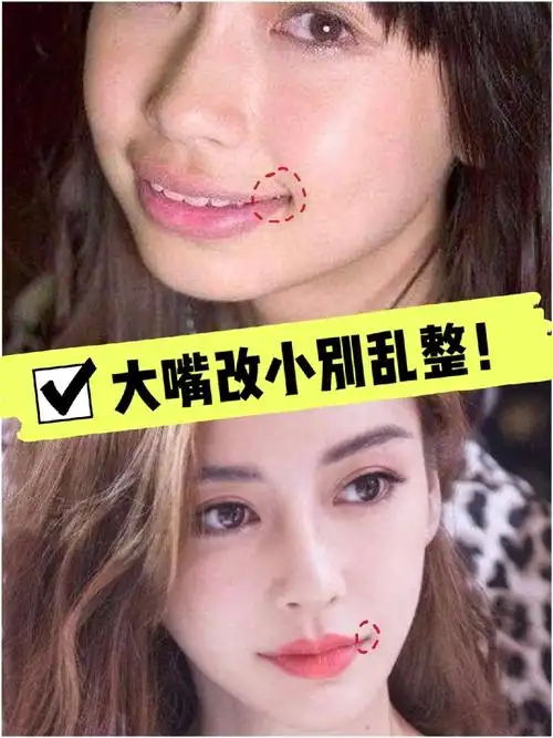 有很多小姐姐感觉嘴巴大,想做小,我也见过几个做_圈子-新氧美容整形