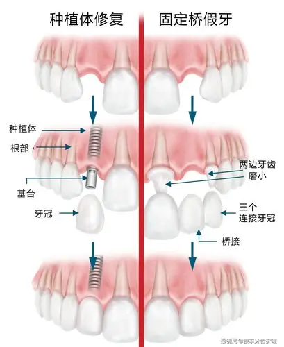 种植牙的利与弊,看完你就可以放心种牙了_口腔