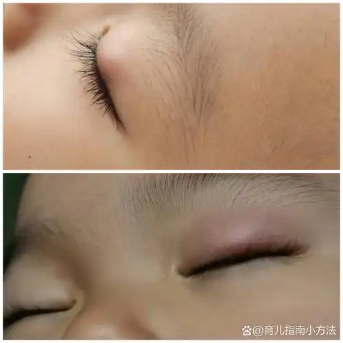 宝宝眼睛肿了,长疙瘩,睑板腺囊肿