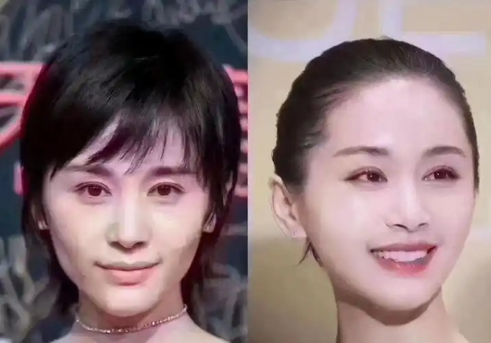 王子文全脸填充变甜美但你是否提前做好了整容风险的心理准备