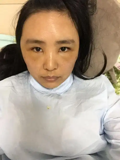自体脂肪填充泪沟和太阳穴第四天,泪沟部位发黄肿胀也很严重,是手术