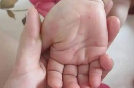孩子的"手足口"病,都是因为这些病引起的,做家长的你知道吗_严重_症状