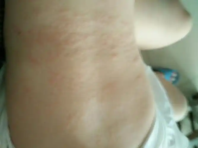 宝宝湿疹怎么办