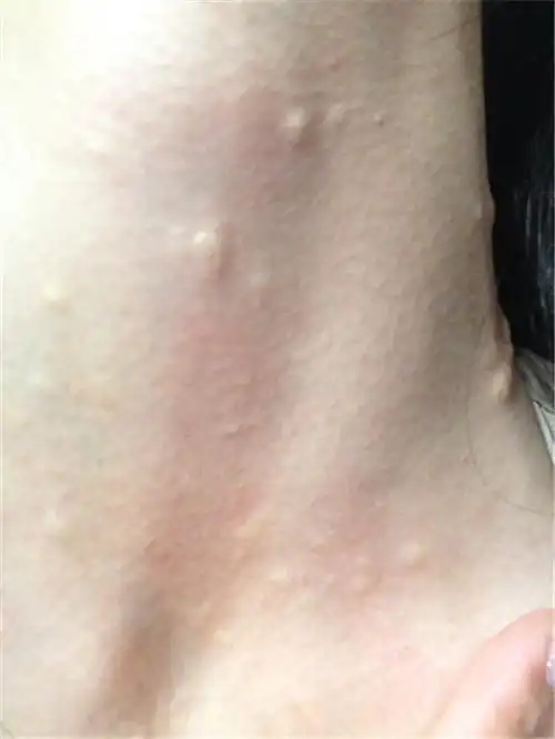 手臂皮下脂肪瘤图片