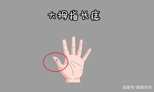 大拇指长痣