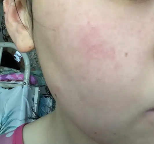 有脸上有红血丝的家人吗谢谢各位美女子0269