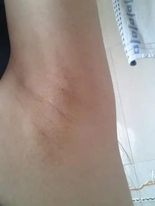 腋下脱毛完就这个样子的,黑黑的,还有像鸡皮一样,怎