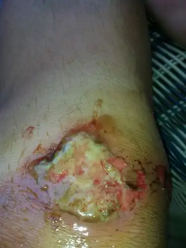 现在伤口都快好了.这两天感觉身体全身