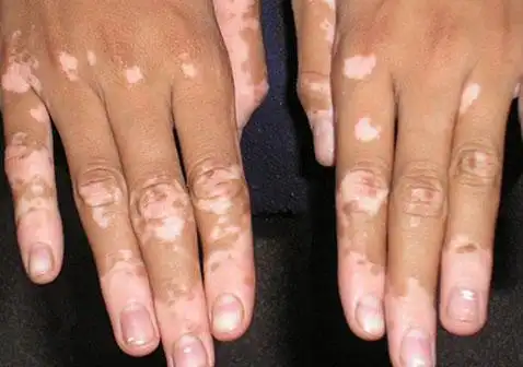 皮肤白斑是什么皮肤病图片及症状治疗方法