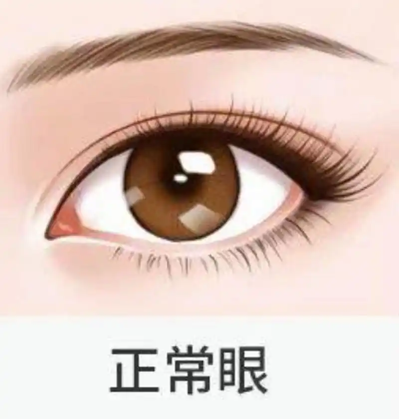 下垂眼睑,是指下眼睑的松弛和下垂,导致眼部外观和功能的问题.