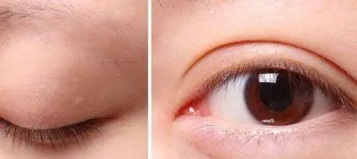 双眼皮术后下眼睑发黄是怎么回事?