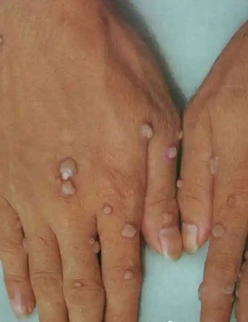 均是人类乳头瘤病毒引起,已知hpv有100多个亚型.