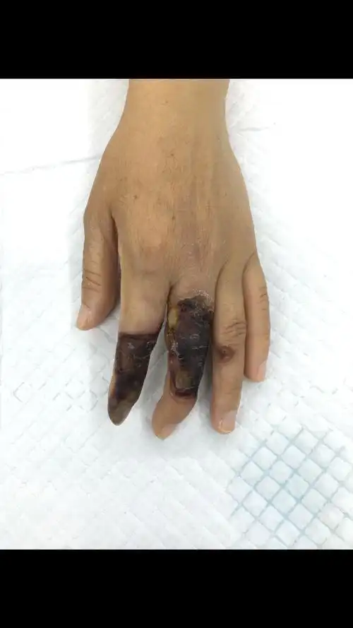 左手食指中指热压伤肌腱关节骨坏死腹部皮瓣修复 - 好大夫在线