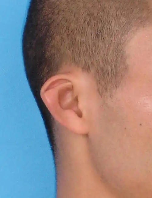 各式各样的耳廓畸形-猿耳_耳部整形_耳部整形症状 - 好大夫在线