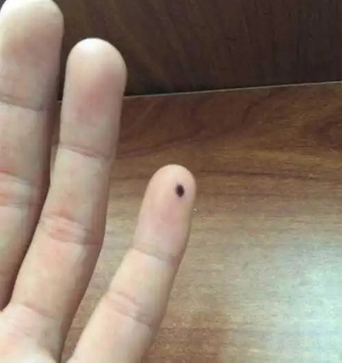 你手指有痣吗不同的手指痣代表不一样的人生