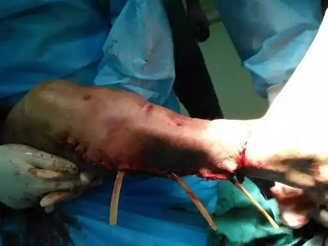 患者平安转入icu继续治疗,断肢再植手术不仅挽回了患者的肢体与生命