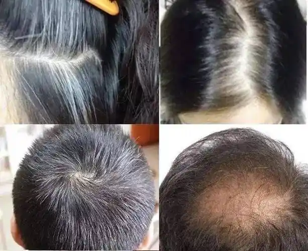 30岁就开始脱发白发87岁头发依旧乌黑浓密秘诀是