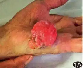 手掌鳞状上皮乳头状瘤伴局灶癌变超声表现1例