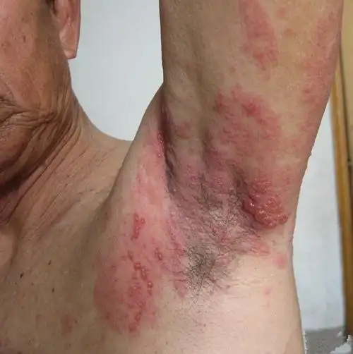 艾滋病片女银屑病的症状图片