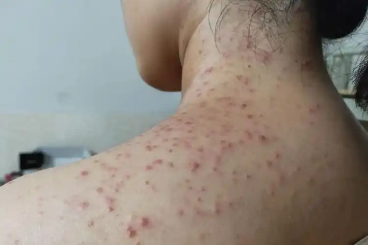 毛囊炎红疙瘩图