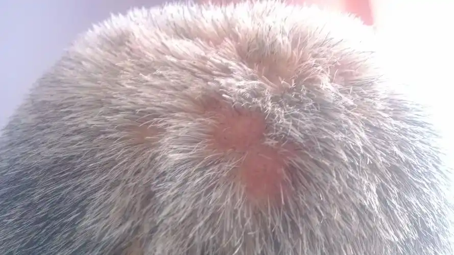 我的父亲头部长了好多疙瘩,大夫说是毛囊炎,但用药后不见好转