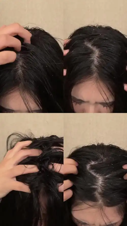 头痒头皮屑困扰抓头发 竖版素材