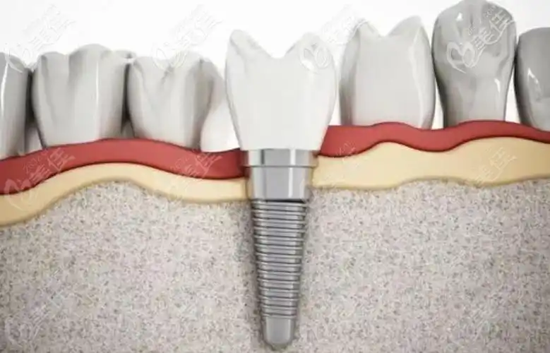 成都比较好的种植牙医院排名公布新桥极光团圆这几家牙科又好又优惠