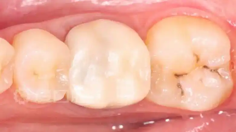 下颌第一磨牙根管再治疗 牙体制备 冠修复1例