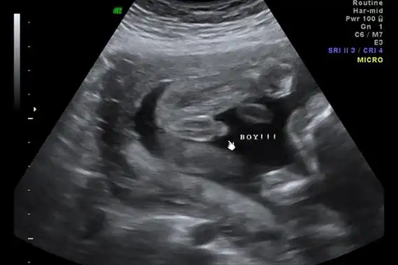 区别图一般来说,怀孕到了四个月的时候,胎儿的生殖器官已经开始发育了