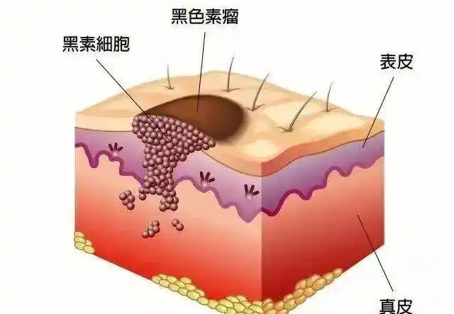一分钟自查黑色素瘤