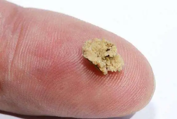 肾结石患者什么都不能吃?错了,搞清楚4条饮食规则照样吃_网易订阅