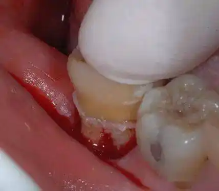 病例分享意向性牙再植术治疗下颌第二磨牙慢性根尖周炎1例