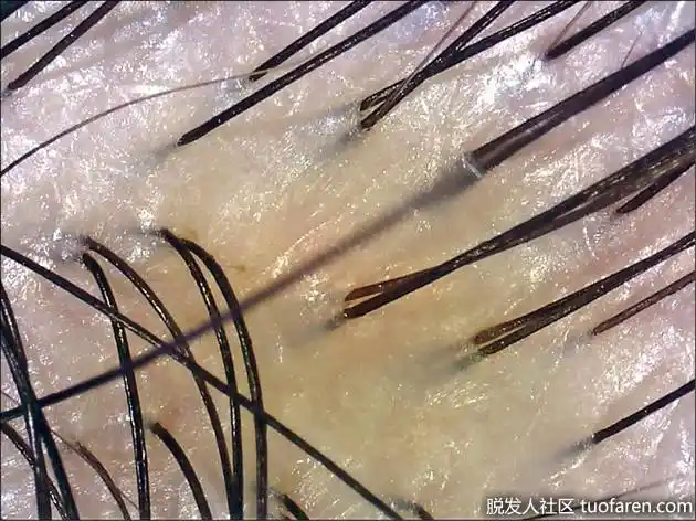 头皮痒屑花片片脂溢性皮炎来作乱