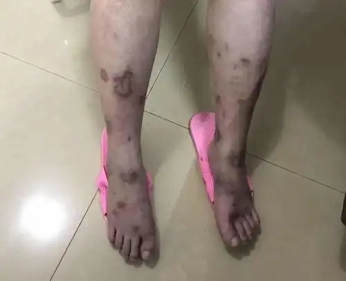 得艾滋病的人皮肤图片