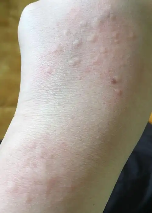 身上出现了很多像蚊子咬一样的包