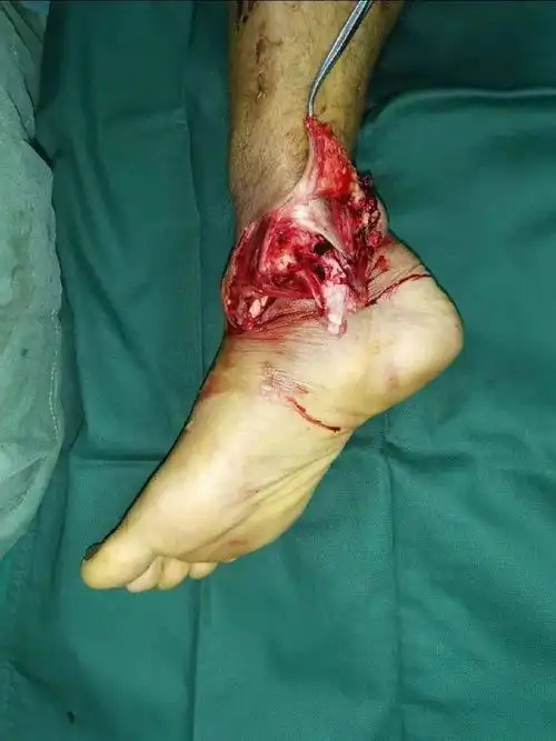 煤矿作业不慎 重物砸断右腿神经 小伙险断肢